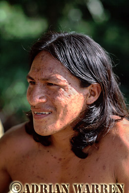 AW_Waorani1106, Waorani Indians : Pante suffering from Chicken Pox, rio Cononaco, Ecuador, 2002
